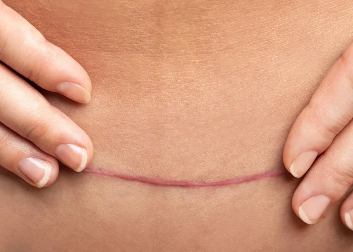 closeup-scar-after-c-section-surgery-female-belly_2