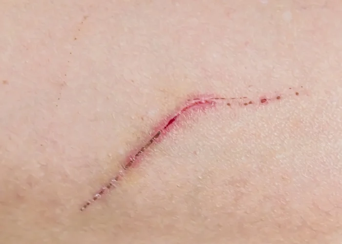 deep-healing-scratch-human-skin
